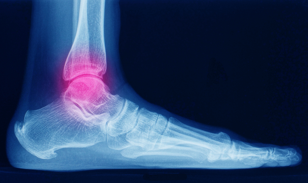 Osteoartrite do tornozelo