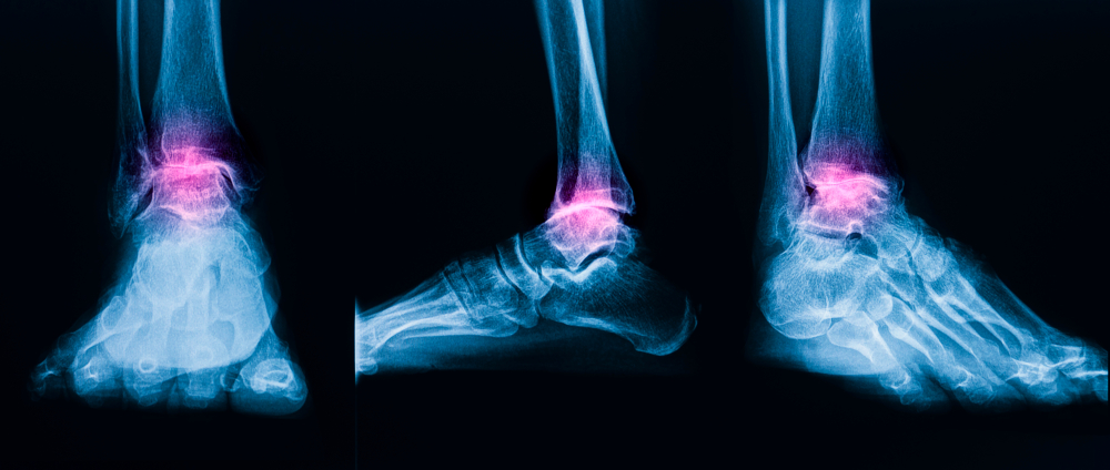 Osteoartrite do tornozelo